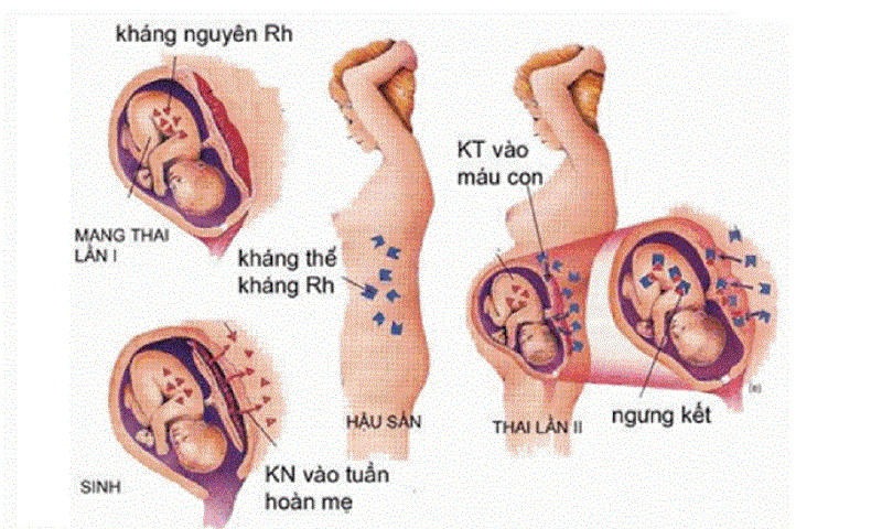Bất đồng nhóm máu mẹ con