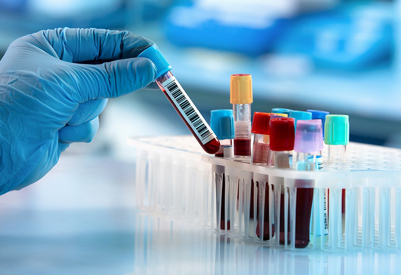 Chỉ số HCT rất quan trọng trong việc đánh giá tình trạng thiếu máu